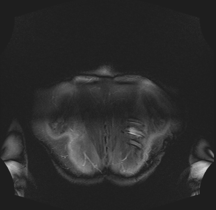 Figure 4 for case Bilateral elastofibroma dorsi